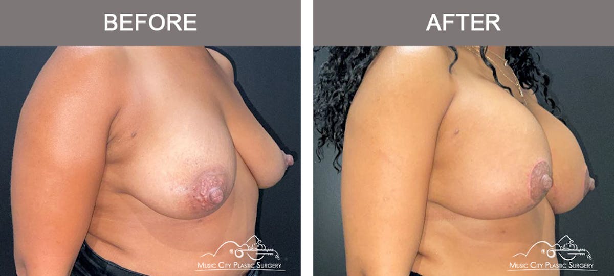 Breast Lift Before & After Gallery - Patient 394634 - Image 2