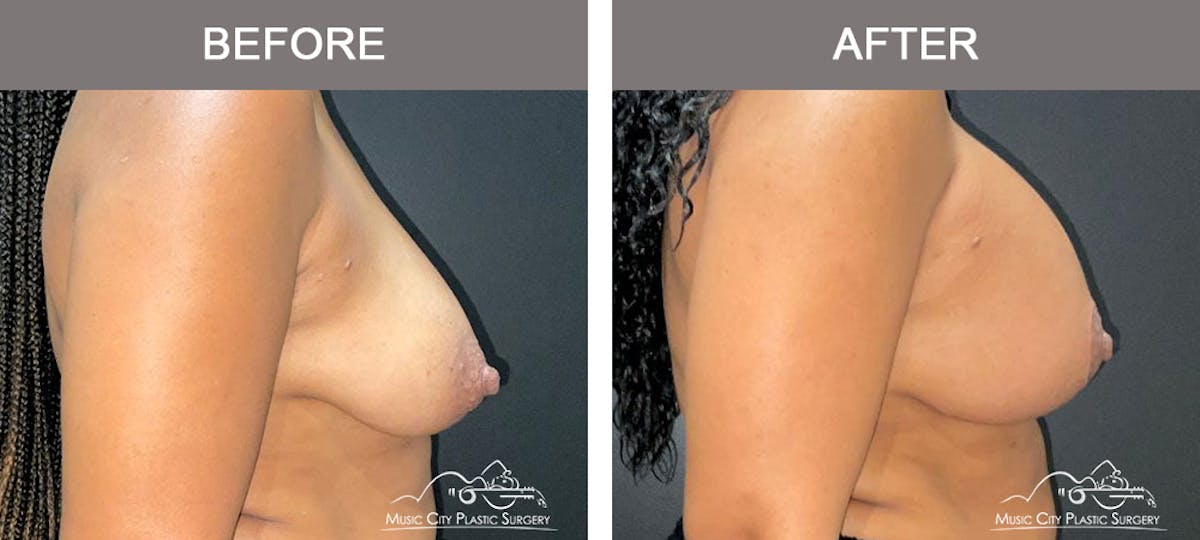 Breast Lift Before & After Gallery - Patient 394634 - Image 3