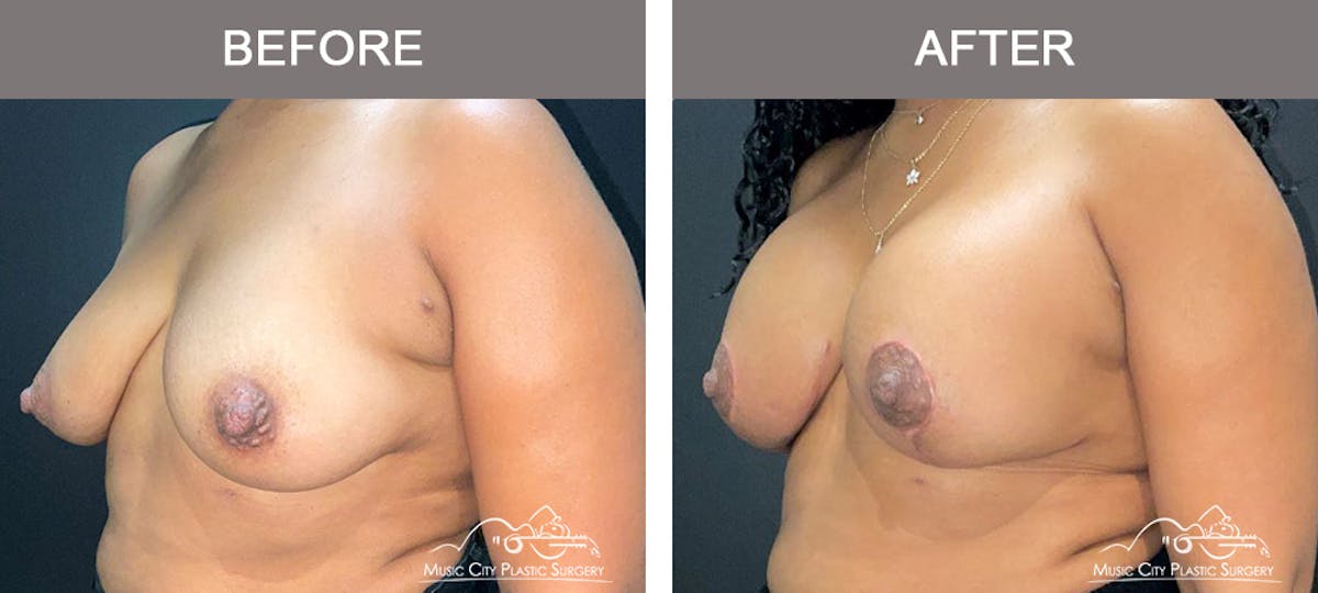 Breast Augmentation Before & After Gallery - Patient 362550 - Image 4