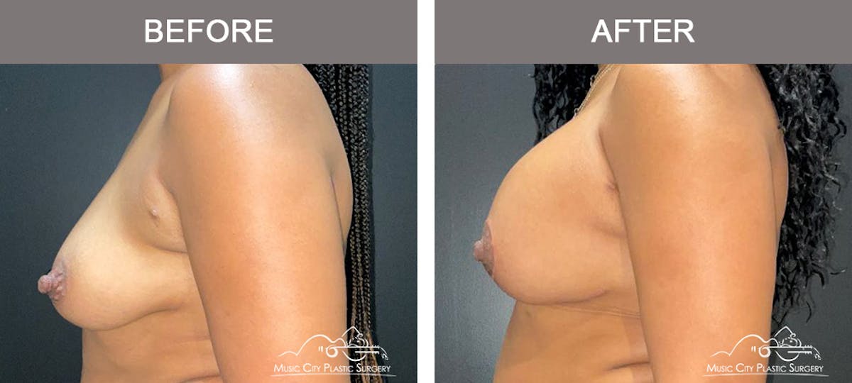 Breast Augmentation Before & After Gallery - Patient 362550 - Image 5