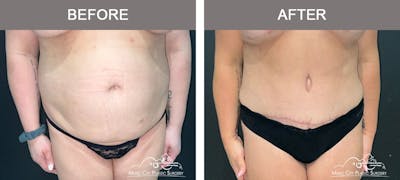 Liposuction Before & After Gallery - Patient 130495 - Image 1