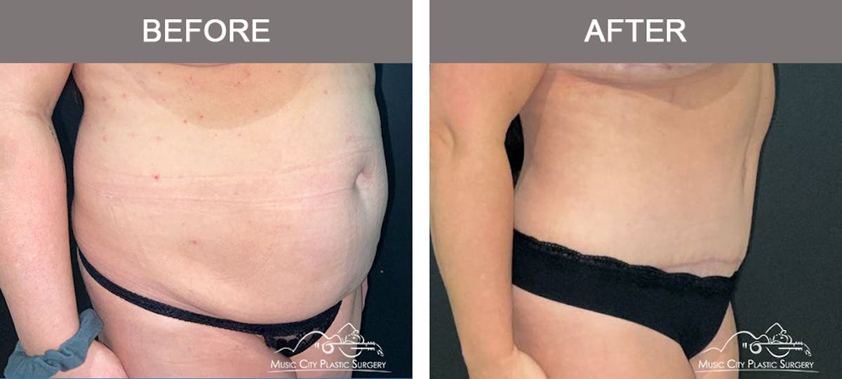 Liposuction Before & After Gallery - Patient 130495 - Image 2