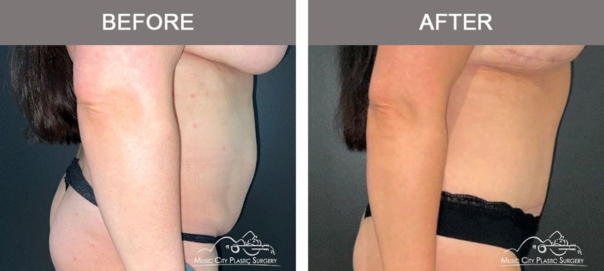Liposuction Before & After Gallery - Patient 130495 - Image 3