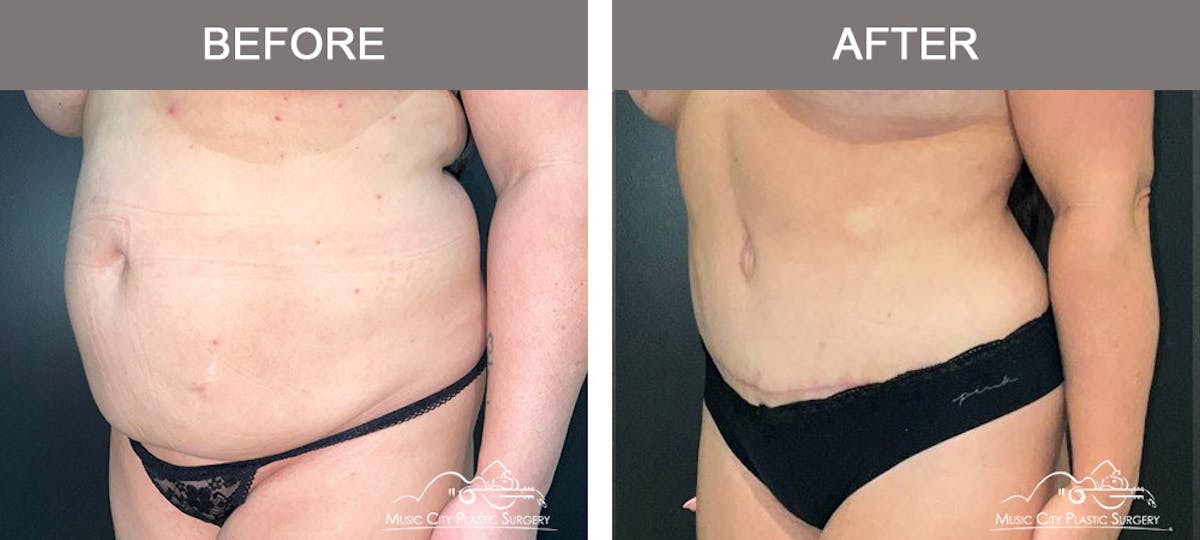 Abdominoplasty Before & After Gallery - Patient 368412 - Image 4