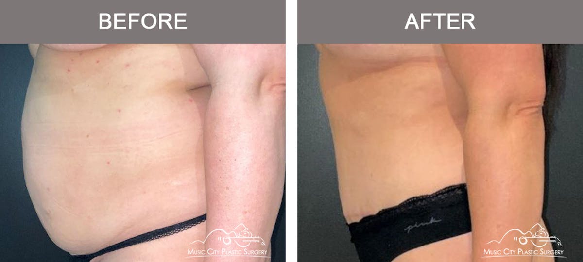 Abdominoplasty Before & After Gallery - Patient 368412 - Image 5