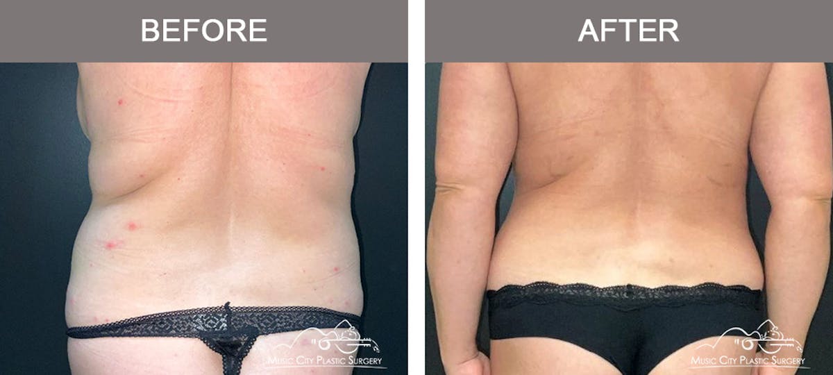 Abdominoplasty Before & After Gallery - Patient 368412 - Image 6