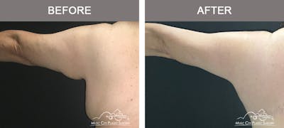 Liposuction Before & After Gallery - Patient 120046 - Image 1