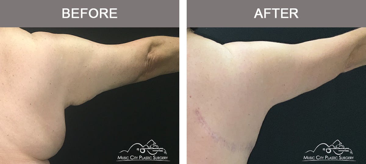 Arm Lift Before & After Gallery - Patient 130290 - Image 2