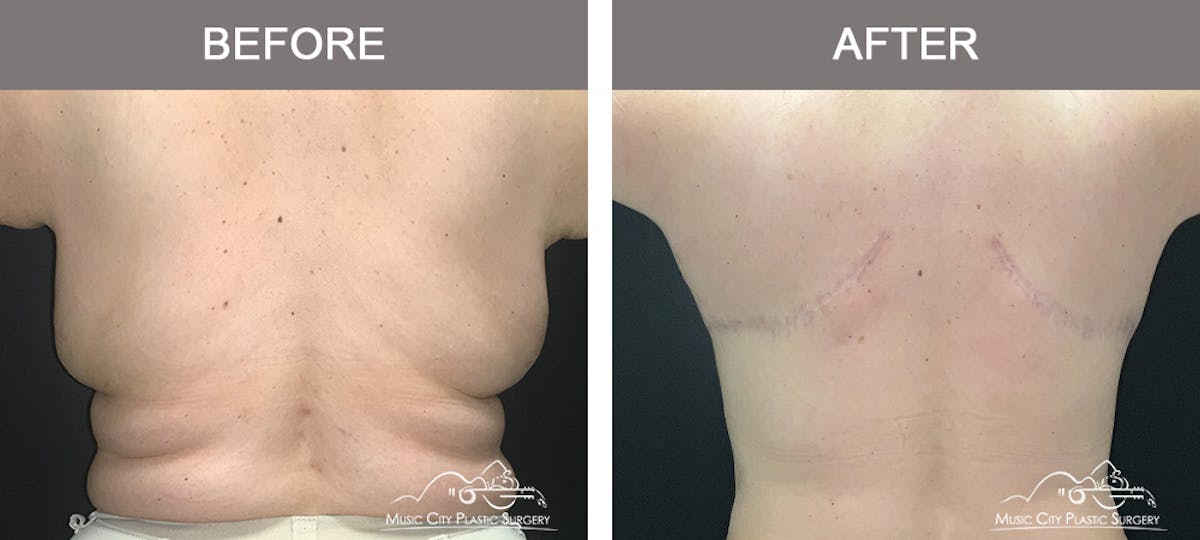Bra Strap Excision Before & After Gallery - Patient 461931 - Image 3