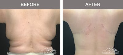 Liposuction Before & After Gallery - Patient 120046 - Image 3