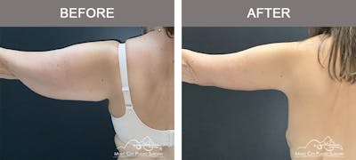 Arm Lift Before & After Gallery - Patient 416537 - Image 1