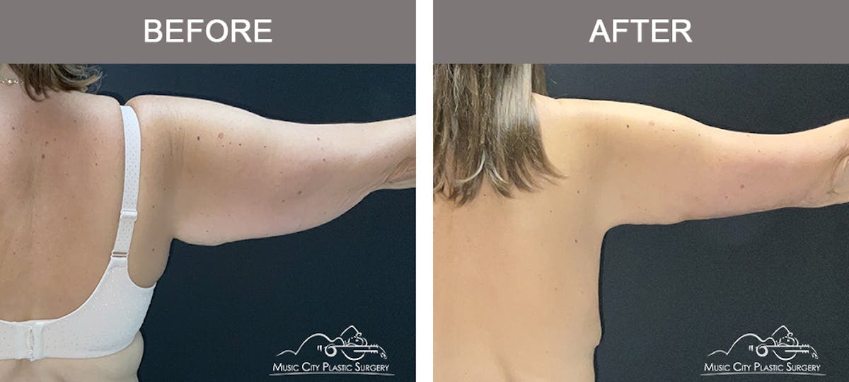 Arm Lift Before & After Gallery - Patient 416537 - Image 2