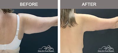 Arm Lift Before & After Gallery - Patient 416537 - Image 2
