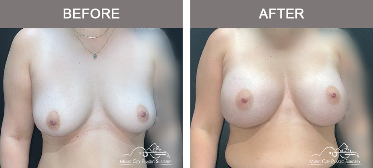 Breast Augmentation Before & After Gallery - Patient 466065 - Image 1