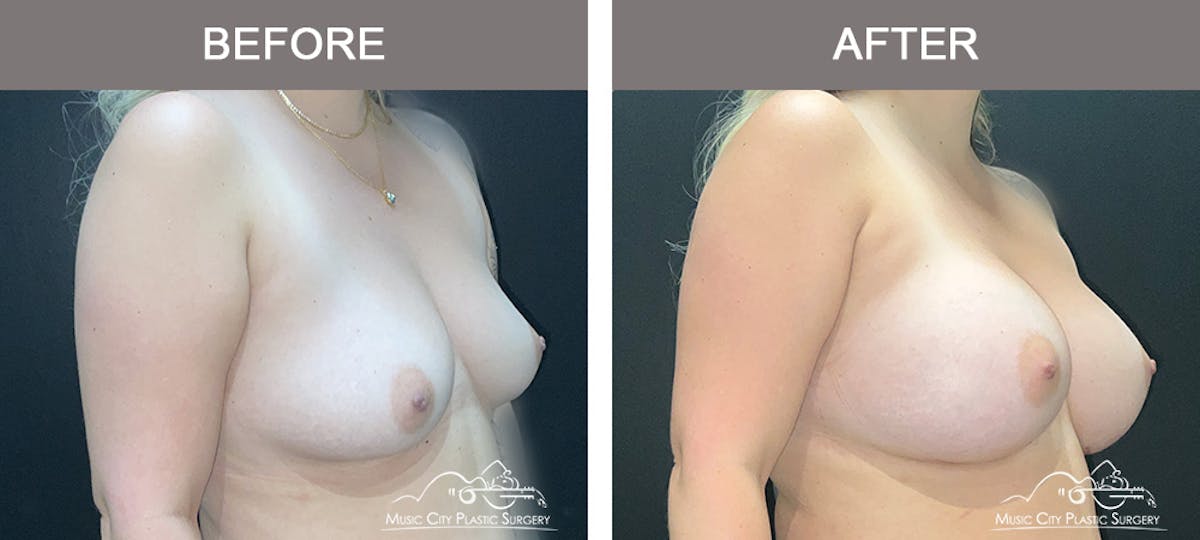 Breast Augmentation Before & After Gallery - Patient 466065 - Image 2