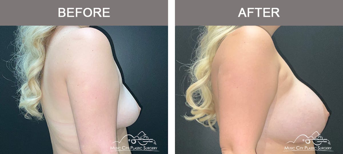 Breast Augmentation Before & After Gallery - Patient 466065 - Image 3