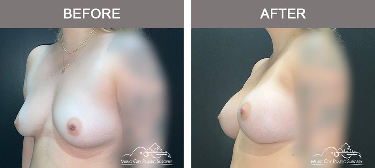 Breast Augmentation Before & After Gallery - Patient 466065 - Image 4