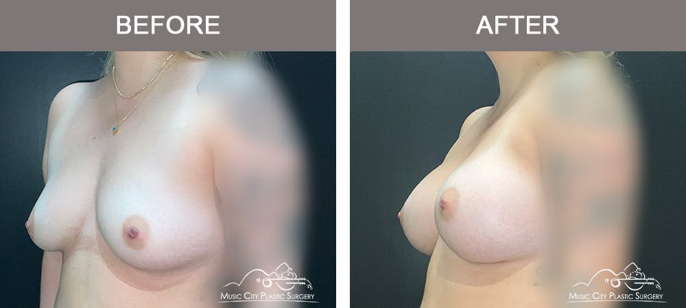 Breast Augmentation Before & After Gallery - Patient 466065 - Image 4
