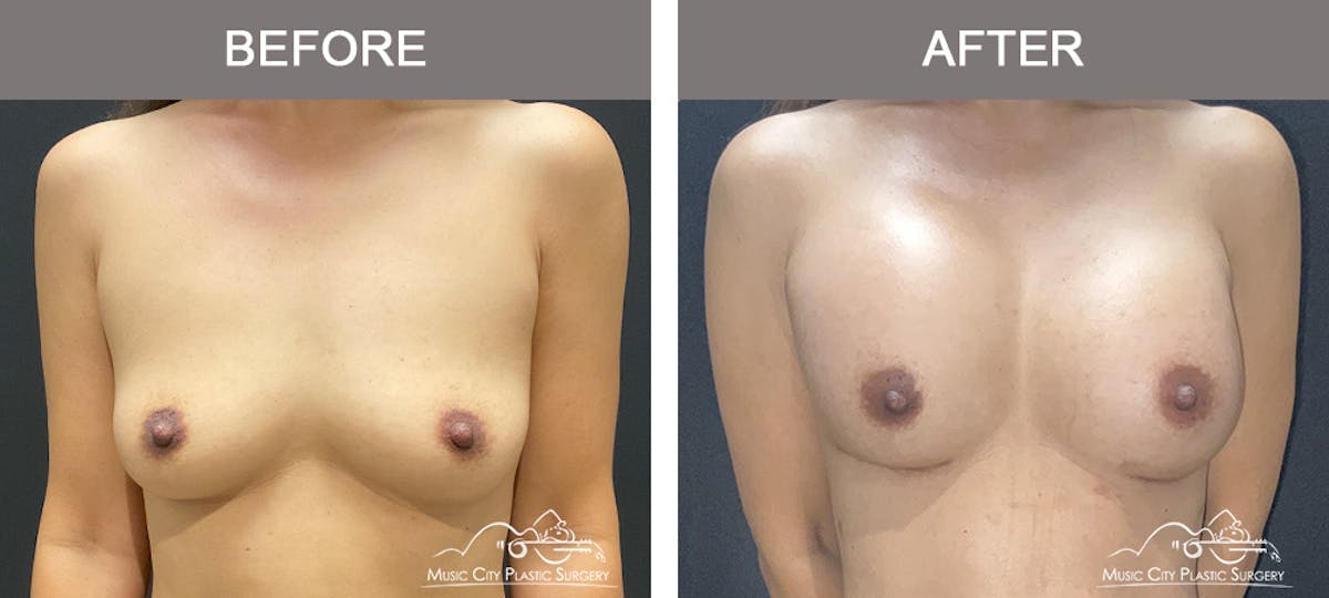 Breast Augmentation Before & After Gallery - Patient 184745 - Image 1