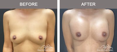 Breast Augmentation Before & After Gallery - Patient 184745 - Image 1
