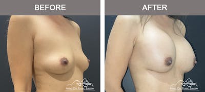 Breast Augmentation Before & After Gallery - Patient 184745 - Image 2