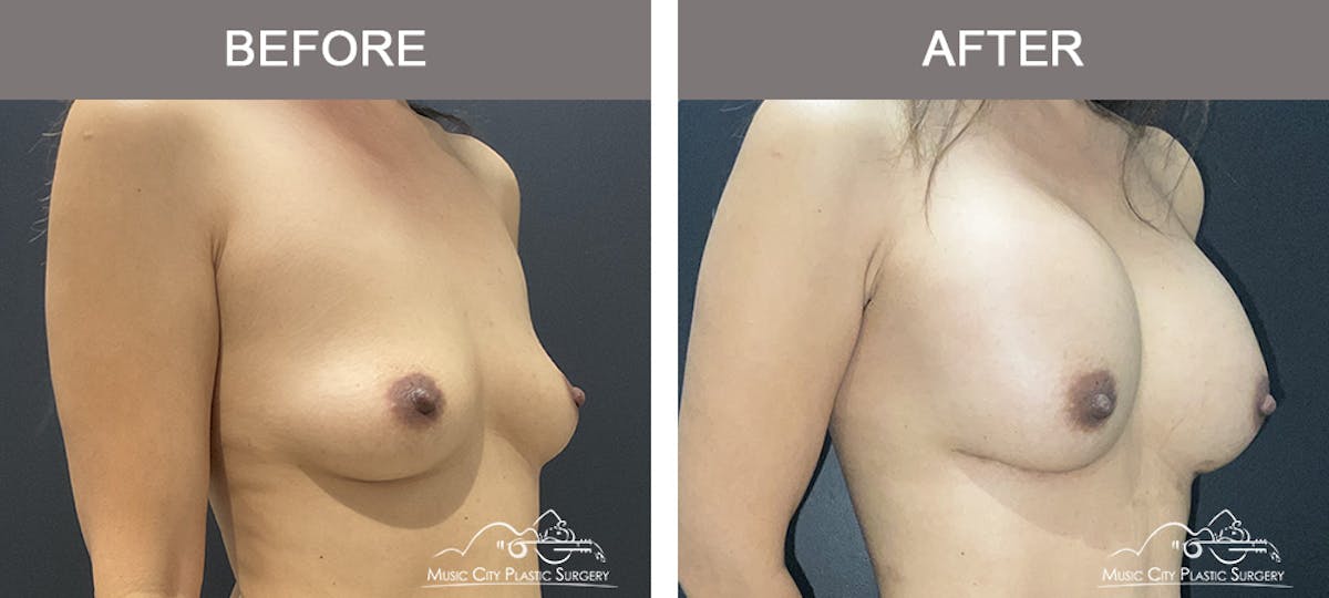 Breast Augmentation Before & After Gallery - Patient 184745 - Image 2