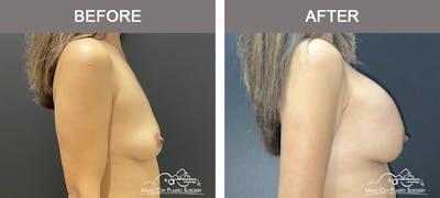 Breast Augmentation Before & After Gallery - Patient 184745 - Image 3