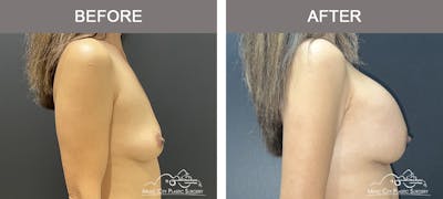 Breast Augmentation Before & After Gallery - Patient 184745 - Image 3