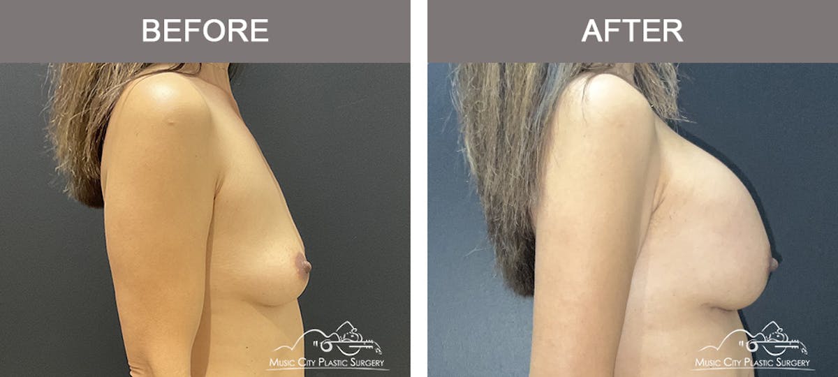 Breast Augmentation Before & After Gallery - Patient 184745 - Image 3