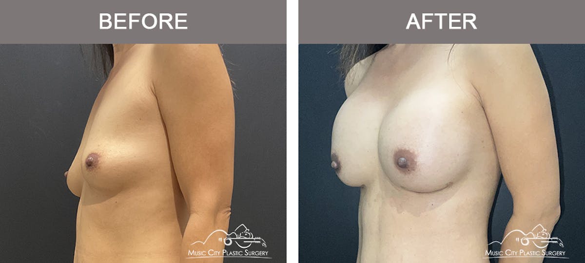 Breast Augmentation Before & After Gallery - Patient 184745 - Image 4