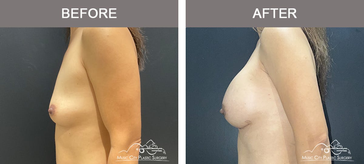 Breast Augmentation Before & After Gallery - Patient 184745 - Image 5