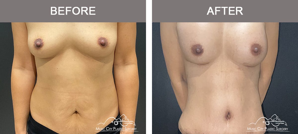 Abdominoplasty Before & After Gallery - Patient 151006 - Image 1