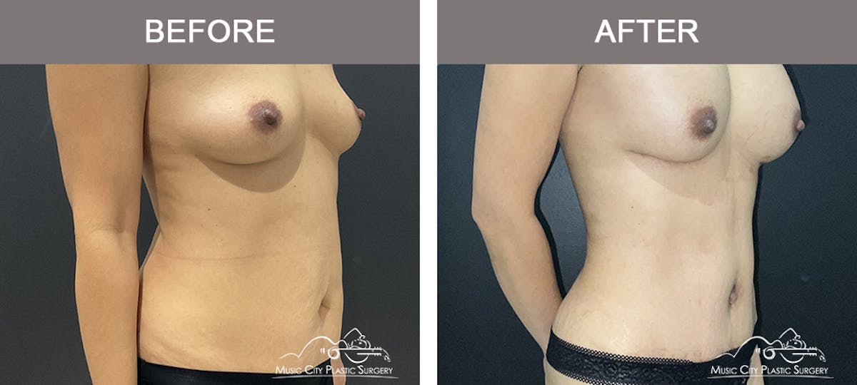 Abdominoplasty Before & After Gallery - Patient 151006 - Image 2