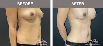 Abdominoplasty Before & After Gallery - Patient 151006 - Image 2