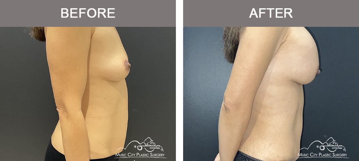 Abdominoplasty Before & After Gallery - Patient 151006 - Image 3