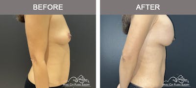 Abdominoplasty Before & After Gallery - Patient 151006 - Image 3