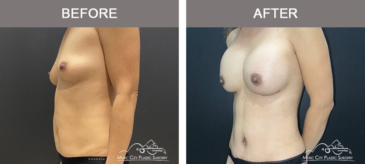 Abdominoplasty Before & After Gallery - Patient 151006 - Image 4