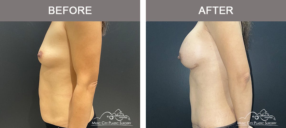 Abdominoplasty Before & After Gallery - Patient 151006 - Image 5