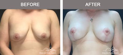 Breast Lift with Augmentation Before & After Gallery - Patient 110050 - Image 1