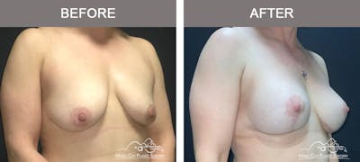 Breast Lift with Augmentation Before & After Gallery - Patient 110050 - Image 2