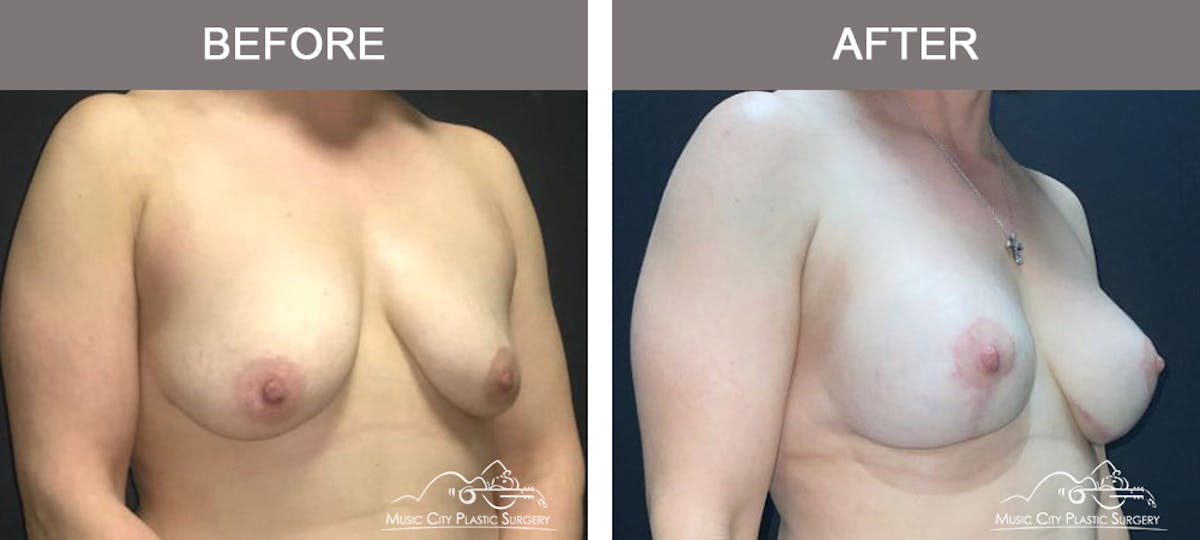 Breast Lift with Augmentation Before & After Gallery - Patient 110050 - Image 2