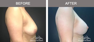 Breast Lift with Augmentation Before & After Gallery - Patient 110050 - Image 3