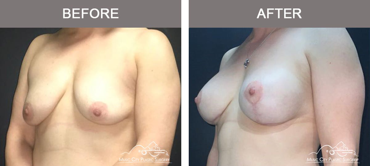 Breast Lift with Augmentation Before & After Gallery - Patient 110050 - Image 4