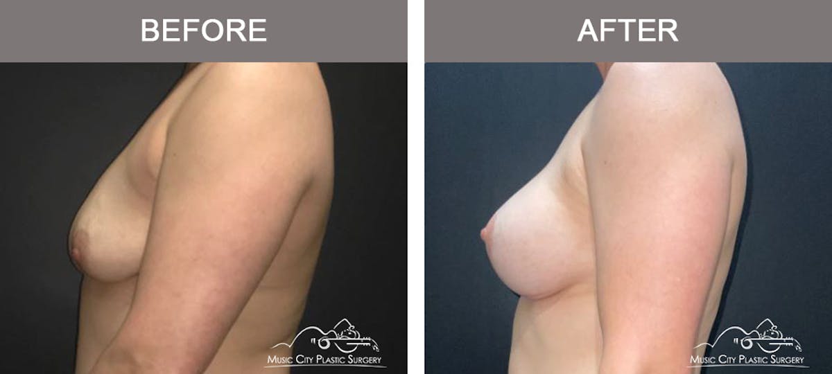 Breast Lift with Augmentation Before & After Gallery - Patient 110050 - Image 5