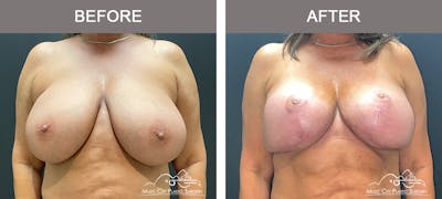 Implant Exchange Before & After Gallery - Patient 351545 - Image 1