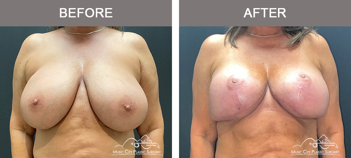 Breast Lift Before & After Gallery - Patient 839003 - Image 1