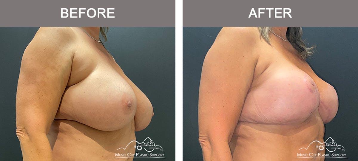 Breast Lift Before & After Gallery - Patient 839003 - Image 2