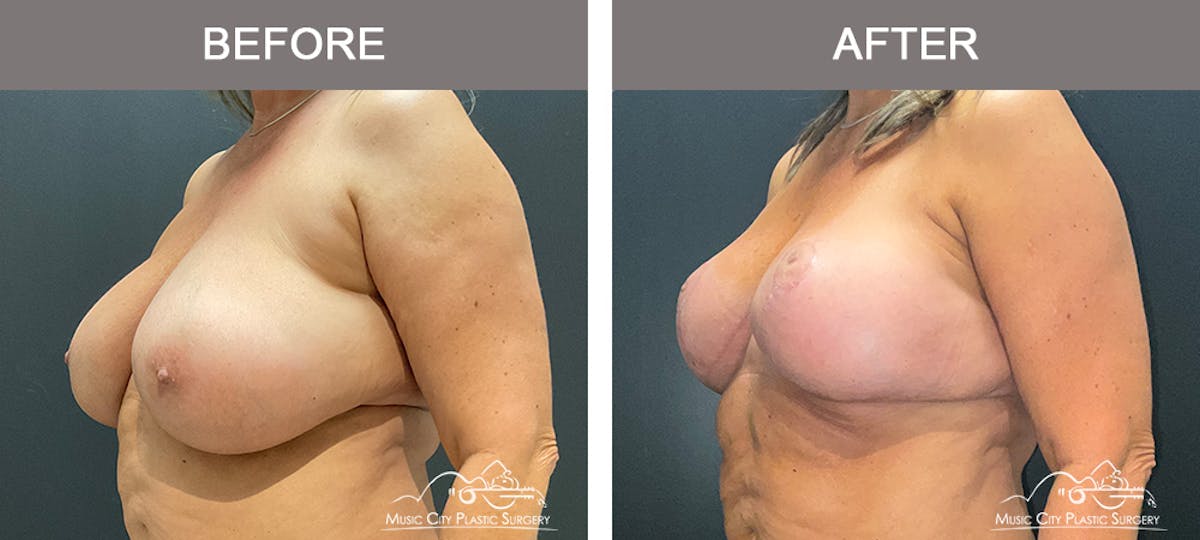 Breast Lift Before & After Gallery - Patient 839003 - Image 4
