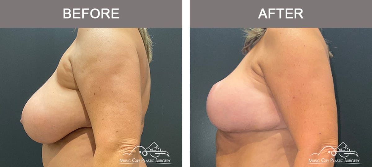 Breast Lift Before & After Gallery - Patient 839003 - Image 5