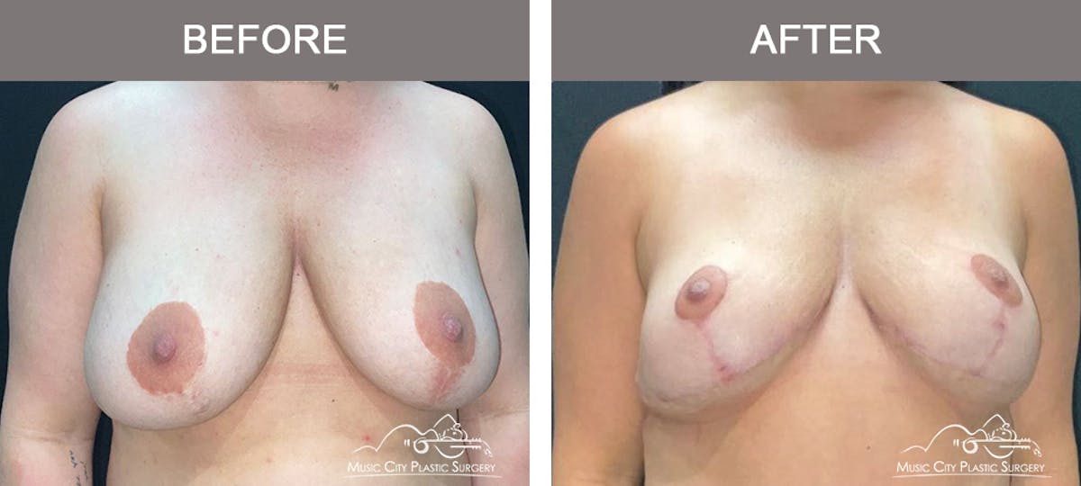 Mastopexy with Capsulectomy Before & After Gallery - Patient 408362 - Image 1